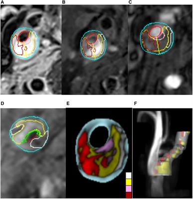 Diagnostic potential of TSH to HDL cholesterol ratio in vulnerable carotid plaque identification